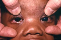 Congenital glaucoma (and cataract) in a 7-month-old infant with CRS. The left eye displays a congenital cataract; the right eye is normal. The infant was operated on on day 3 of life to correct the congenital cataract.