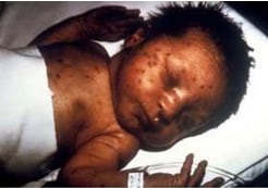 Infant with congenital rubella and “blueberry muffin” skin lesions. 