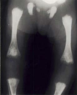 Radiolucent bone disease. X-ray of the lower limbs in a newborn with CRS.