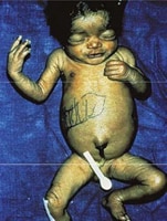 Hepatosplenomegaly and jaundice in an infant with congenital syphilis. Black markings on infant indicate liver margins.
Photograph source: Dr Ronald Ballard.
