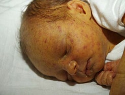 Petechial rash (blueberry muffin rash) and jaundice in infant with cCMV.
