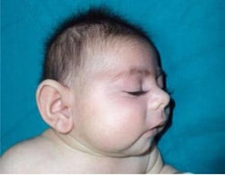 Microcephaly in an infant with cCMV.