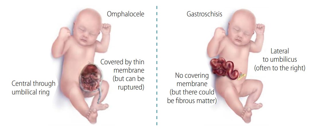 Visual aid for differentiating omphalocele and gastroschisis