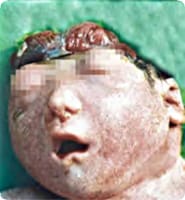 Photo of baby with Anencephaly