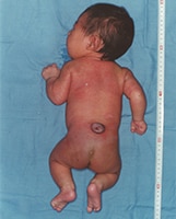 Photo of baby with Lumbar spina bifida
