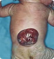 Photo of baby of Spina bifida