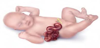 Illustration of baby with Gastroschisis