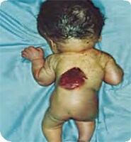 Photo of baby with Thoracic spina bifida