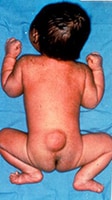 Photo of baby with Lumbar spina bifida