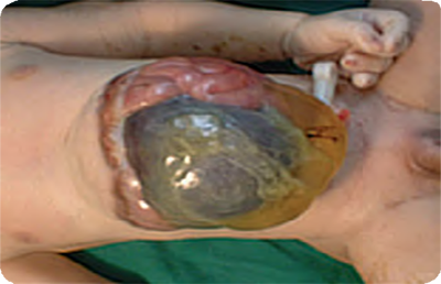 Large abdominal midline defect.  Some organs outside abdomen.