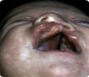 Photo of baby with Cleft lip and palate unilateral