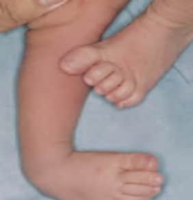 Photo of baby with Talipes equinovarus