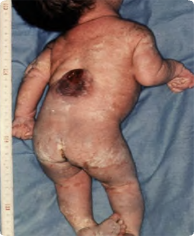 Photo of baby with Thoracic spina bifida with hydrocephalus