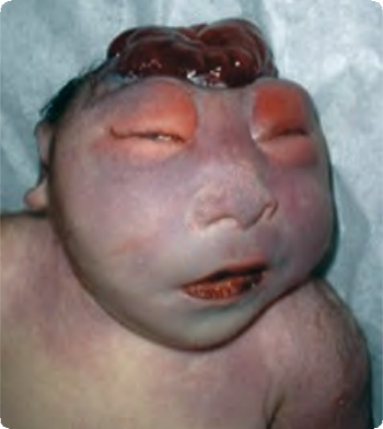Photo of baby with Mero-anencephaly (incomplete)