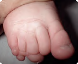 Photo of baby with Partial absence of toes