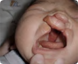 Photo of baby with Bilateral cleft lip
