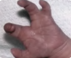 Photo of baby with Absent third finger