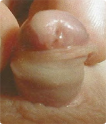Photo of baby with hypospadias