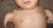 Photo of baby with upper limb defect
