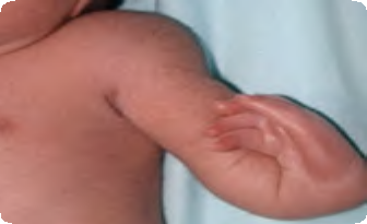 Photo of Radial (preaxial) deficiency
