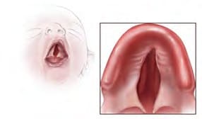 Illustration of baby with Cleft palate