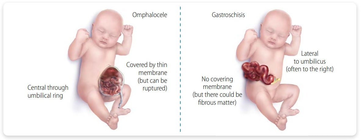 Distinguishing omphalocele from gastroschisis