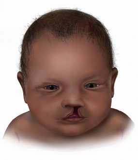 Graphic of baby with cleft lip unilateral