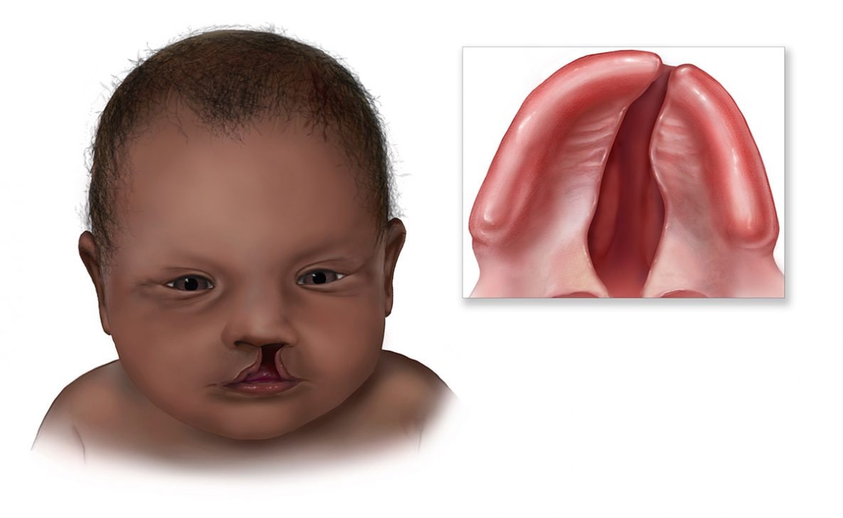 Graphic of baby with newborn cleft lip palate