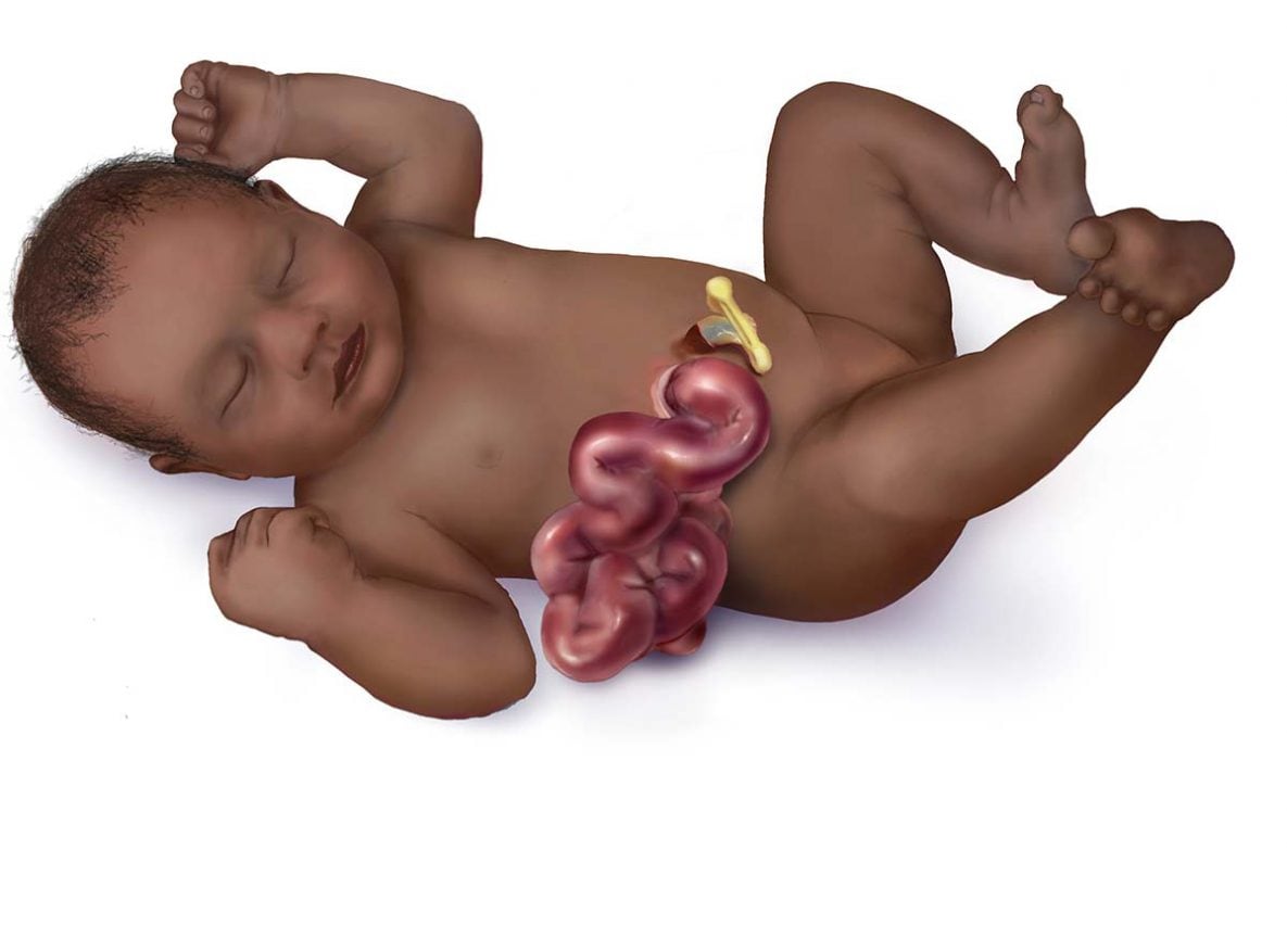 graphic of a baby with gastroschisis