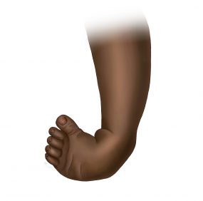 Graphic of a clubfoot