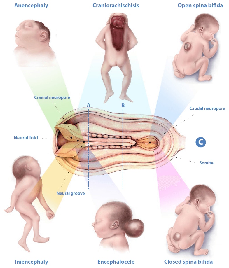 Neural tube defects detailed illustration