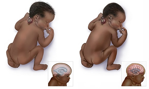 Graphic of babies with cervical open spina bifida & cervical open spina bifida hydrocephalus