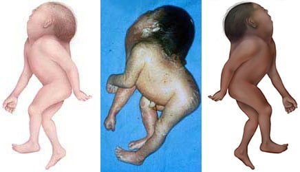 Image of babies with inencephaly