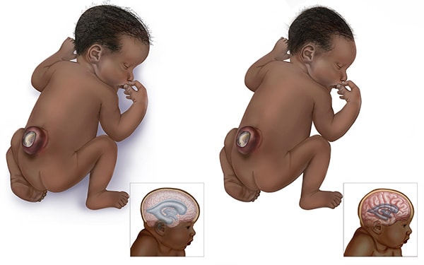 Graphic of babies with lumbar open spina bifida hydrocephalus & lumbar spina bifida