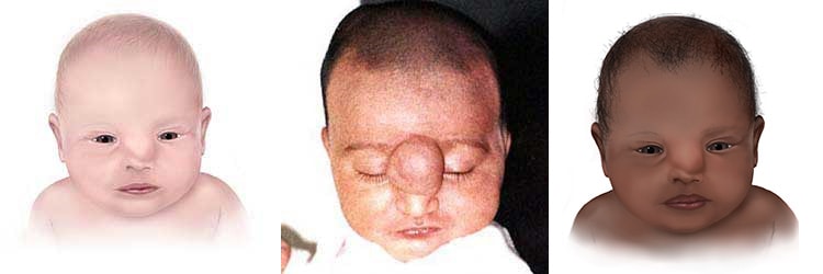 Image of a baby with nasal encephalocele