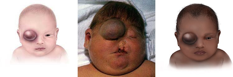 Graphic of baby with orbital encephalocele