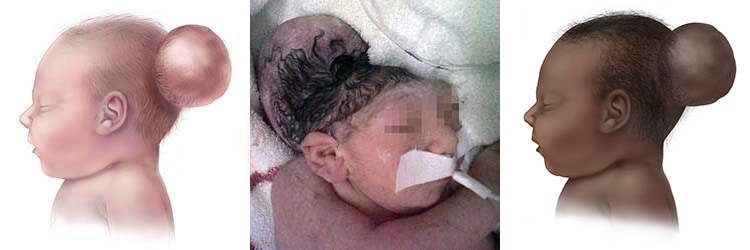 Graphic of baby with parietal encephalocele
