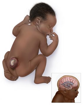 Graphic of a baby with sacral spina bifida