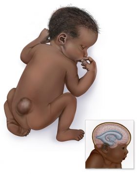 Graphic of baby with sacral spina bifida hydrocephalus