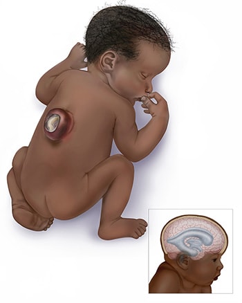 Graphic of a baby with thoracic open spina bifida hydrocephalus
