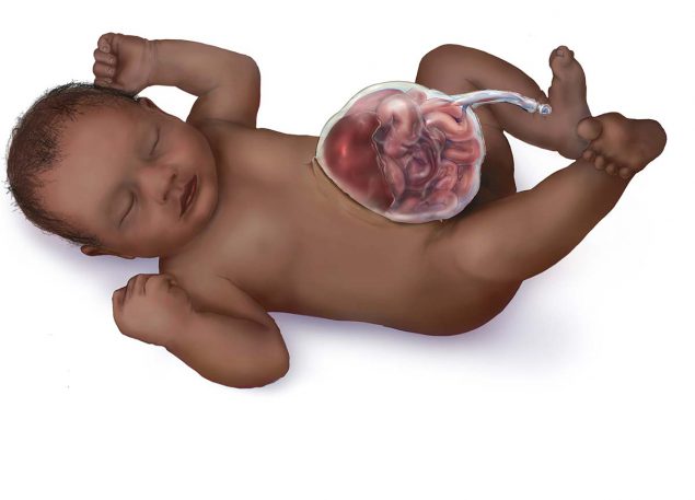 image of a baby with omphalacele