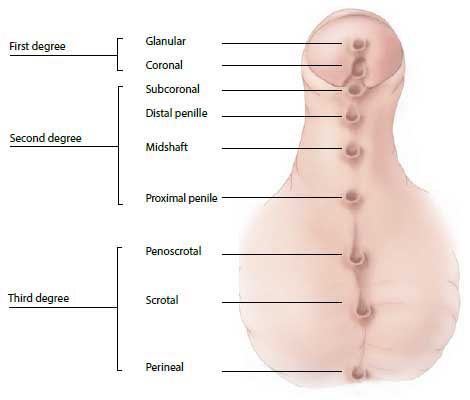 anomalii ale penisului tipuri de penisuri la bărbați