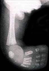 Talipes equinovarus x-ray