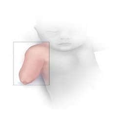 Congenital absence of forearm and hand illustration