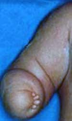 Congenital absence of forearm and hand photograph