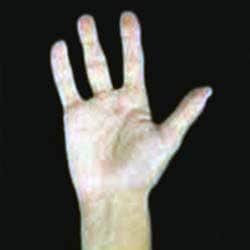 Oligodactyly of the hand photograph