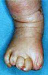 Aphalangia of the feet. Partial absence of the phalanges photograph