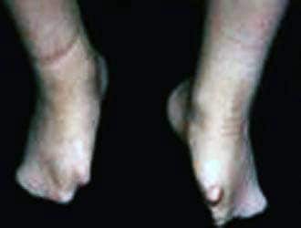 Adactyly of the feet photograph