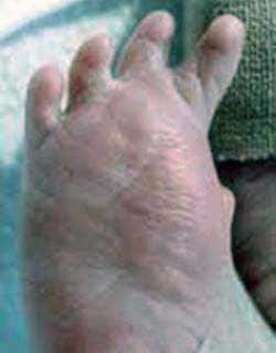 Oligodactyly of the foot (absent hallux) photograph