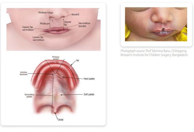Fig. 25. Anatomy of the lip and palate & Fig. 26. Median cleft lip